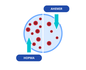 Як виглядає залізодефіцитна анемія: порівняння нормального стану і кількості еритроцитів у крові при анемії